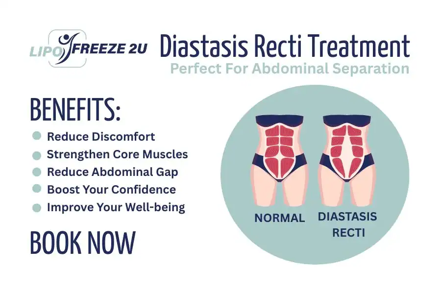 How Long Will It Take to See Improvements in Diastasis Recti Marylebone