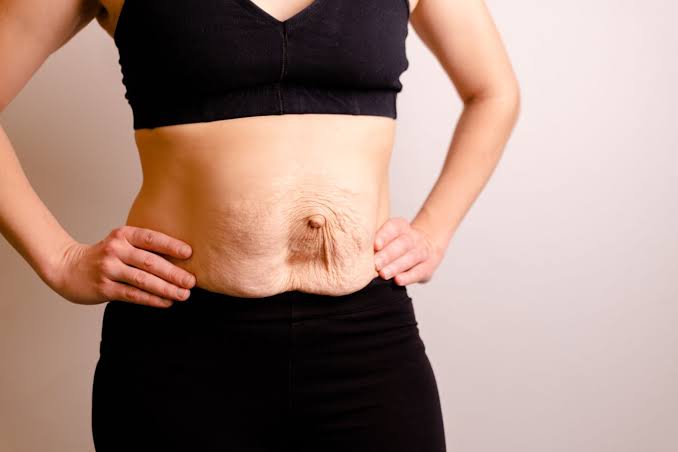 Is Surgery Really the Only Way to Repair Diastasis Recti Marylebone?