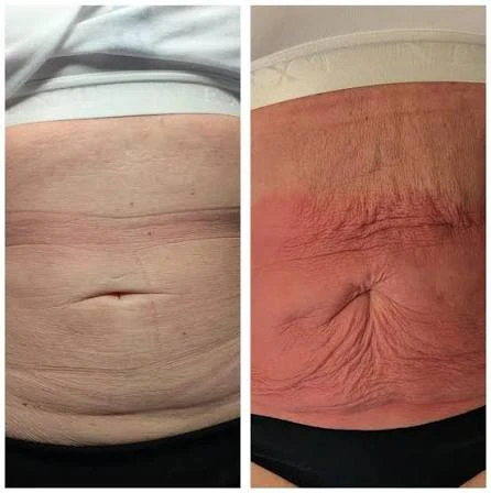 How Does RF Microneedling Improve Crepey, Thin and Uneven Skin Texture Marylebone?