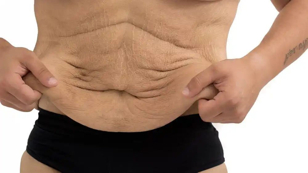 RF Microneedling for Loose Skin: How Can It Help Tighten and Reshape the Skin Marylebone?
